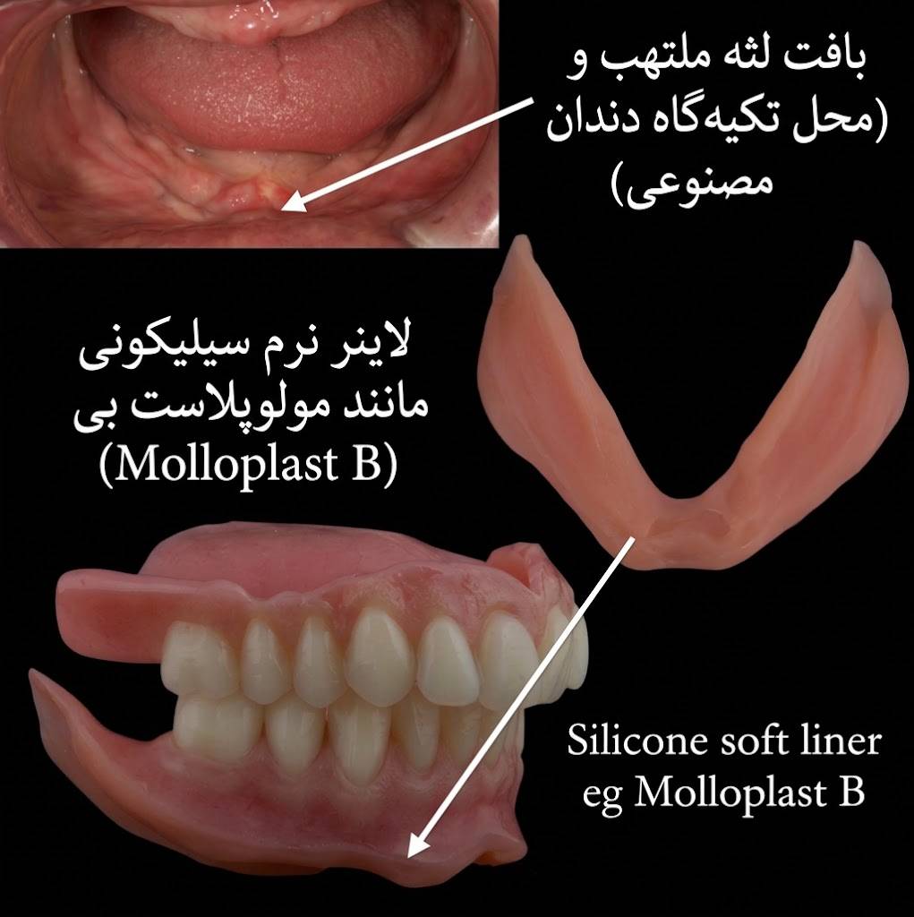 لثه نرم مولوپلاست